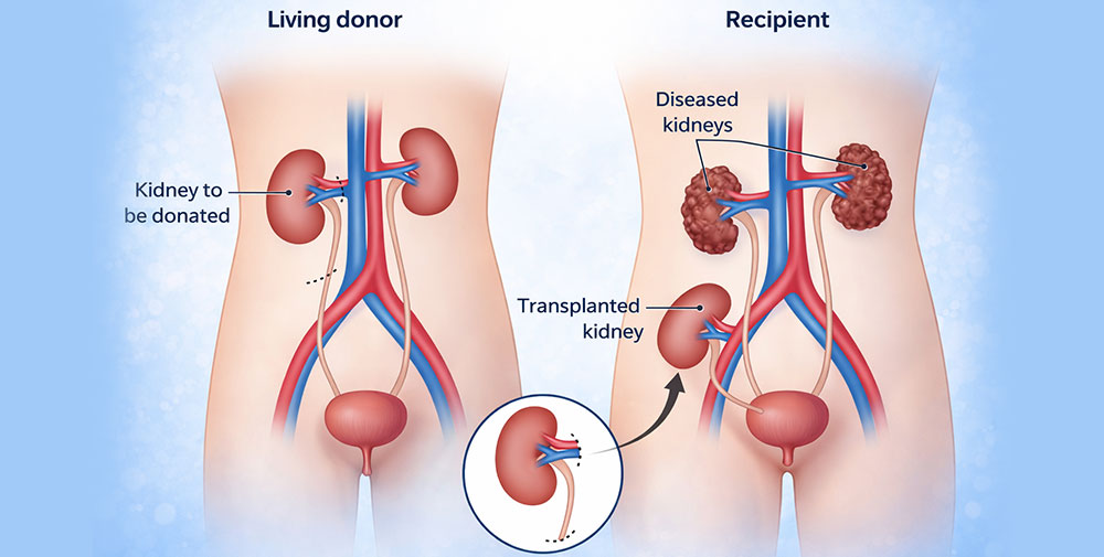 Dialysis Treatment
